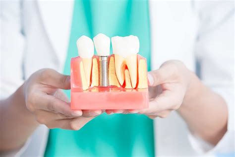 dental implants ashford